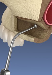 Patient in Parker holding cheek due to a cavity