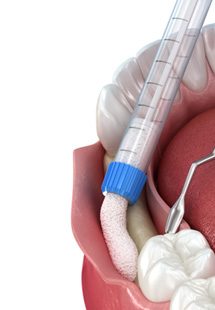 Patient in Parker showing lost tooth
