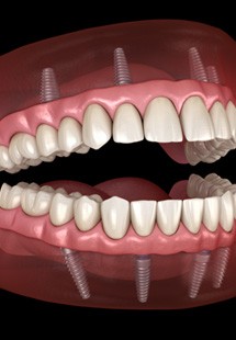Patient in Parker holding clear aligners