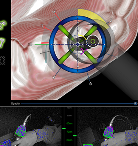 Digital model of a dental implant being surgically placed