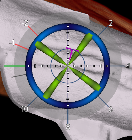 Scope showing the ideal location in the jawbone for dental implant placement