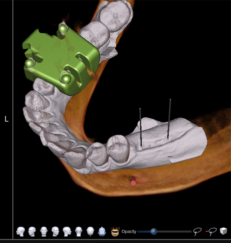 Digital model of the lower jawbone