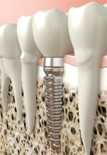 Digital illustration of a dental implant