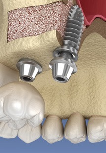 Illustration of a sinus lift