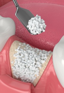 Digital illustration of a bone graft