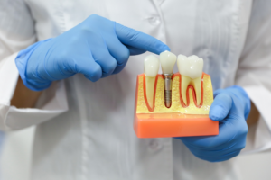 a model of dental implants