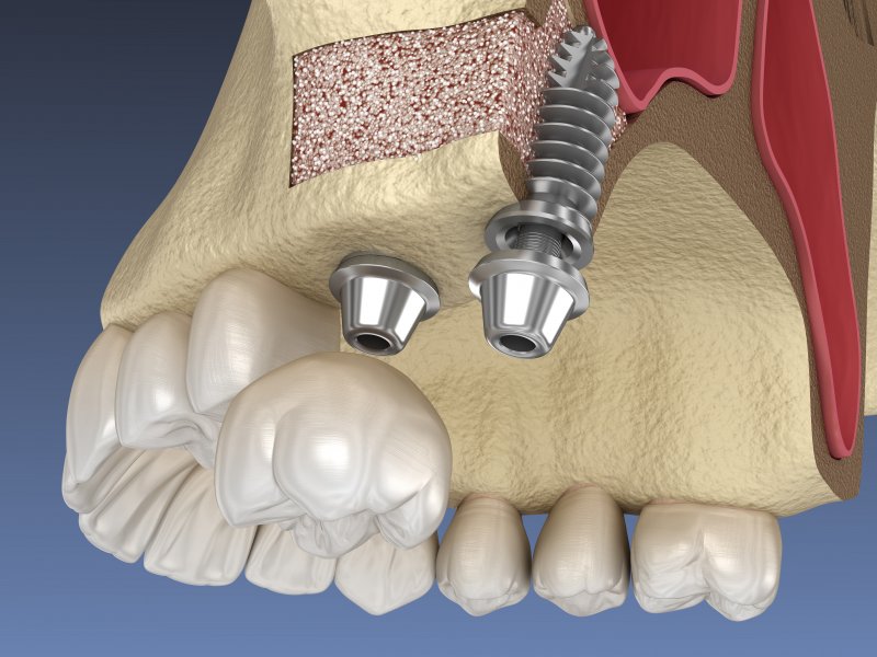 Digital illustration of a sinus lift